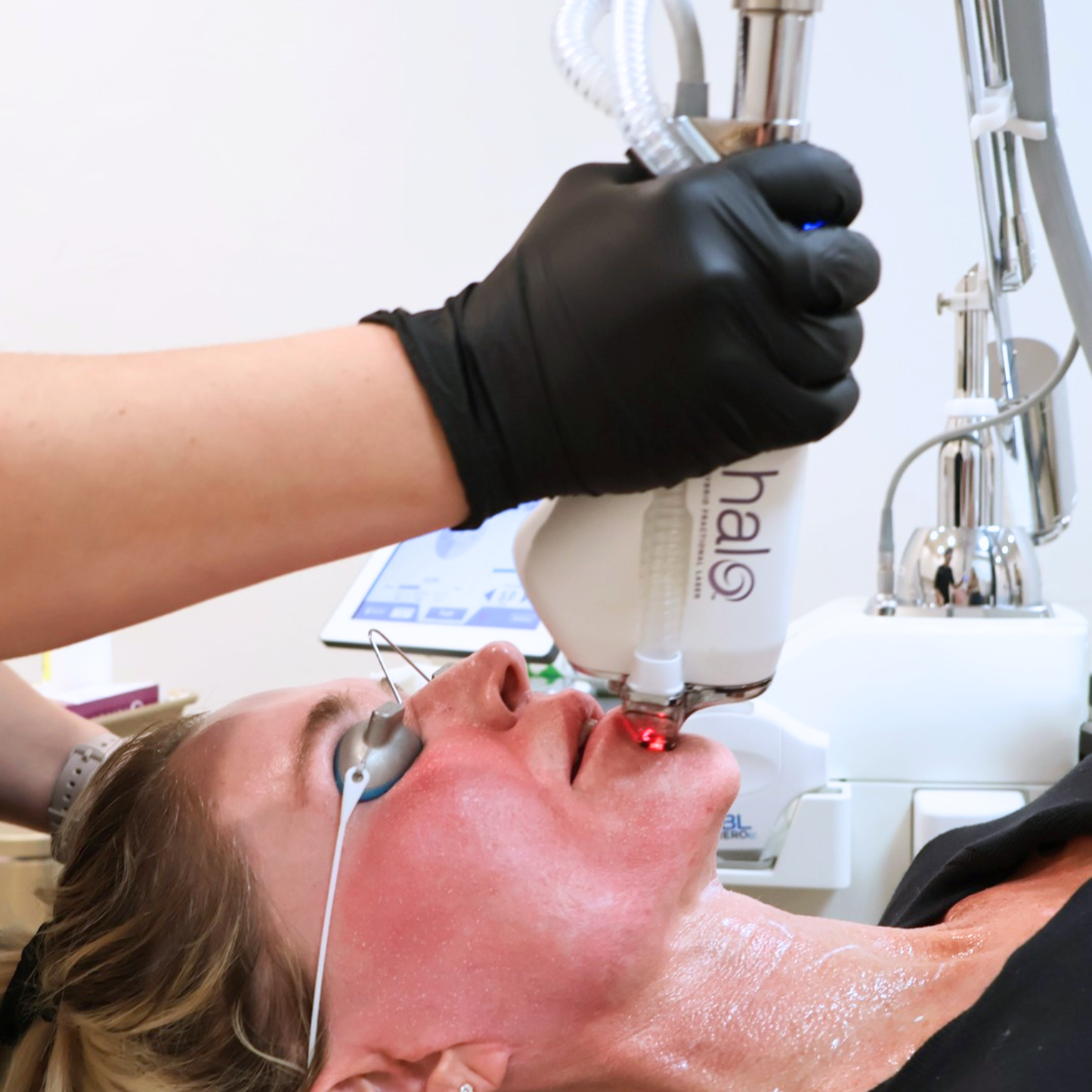 HALO Laser - Face & Neck Treatment