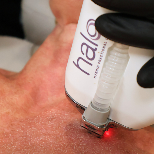 HALO Laser - Face, Neck & Chest Treatment