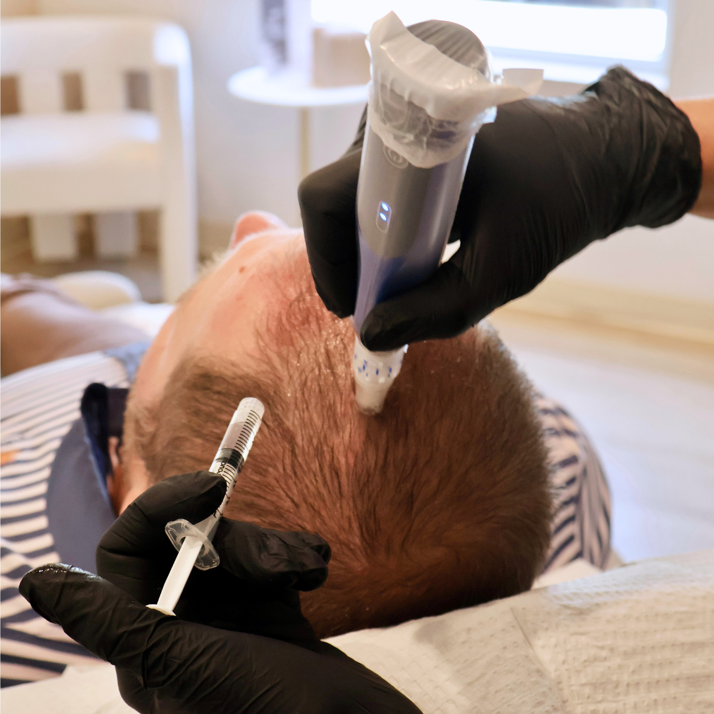 Hair Restoration with SkinPen & PRP